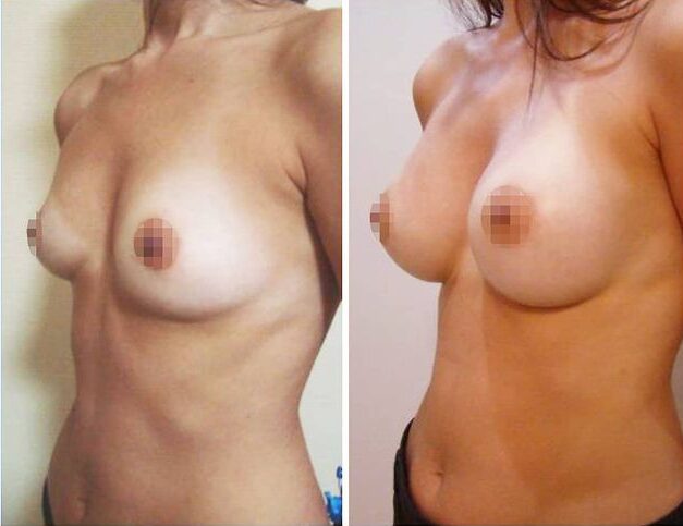 Breast plastic surgery
