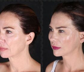 Face lifting - Spider Web