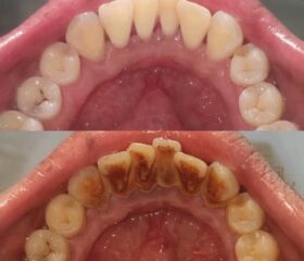 Чищення зубних відкладень
