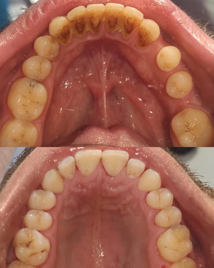 Чистка зубных отложений