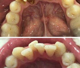 Чищення зубних відкладень
