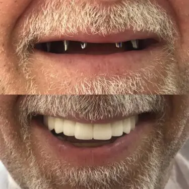 Aesthetic dentistry in Turkey