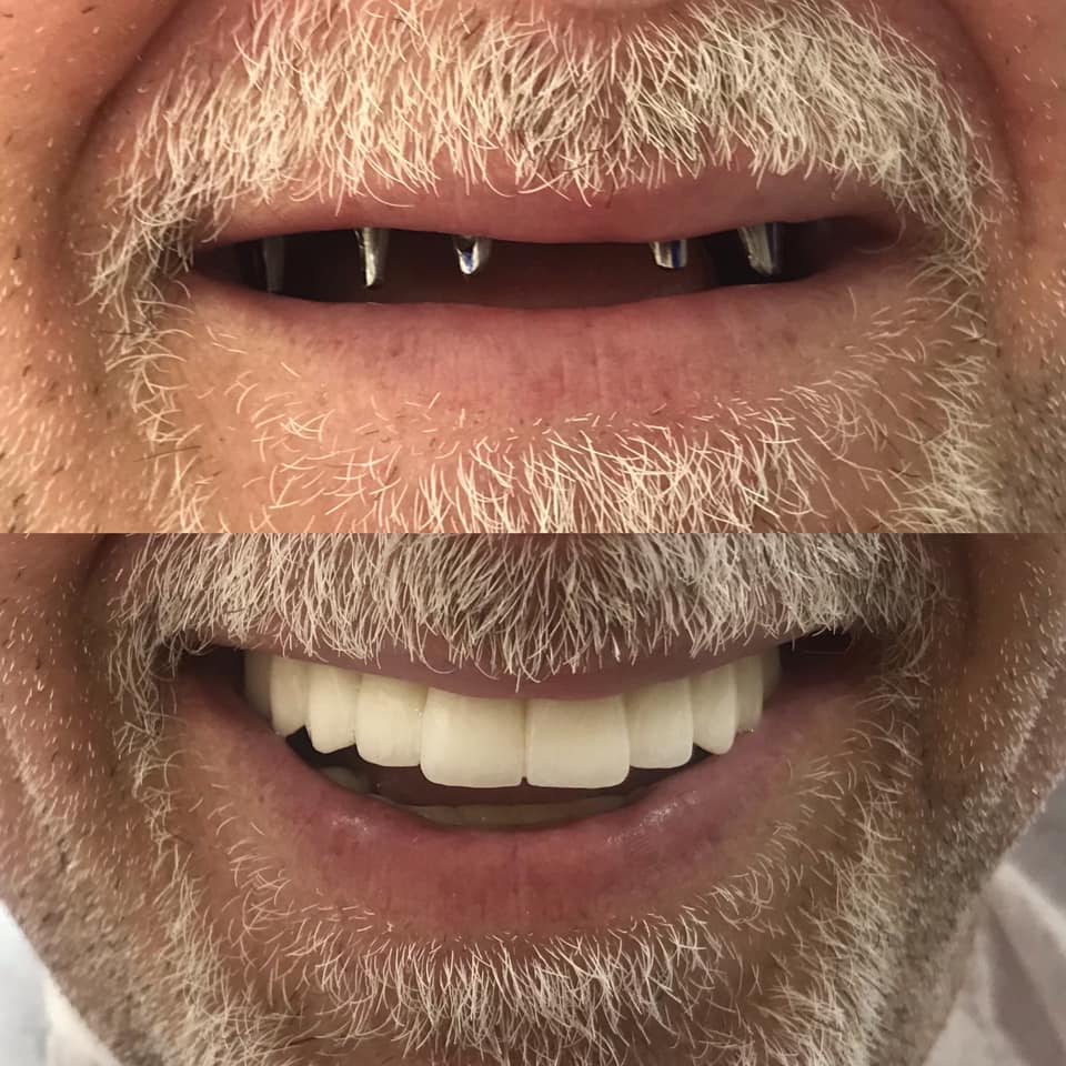 Implantes dentales 