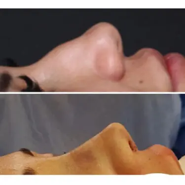 Rhinoplastik