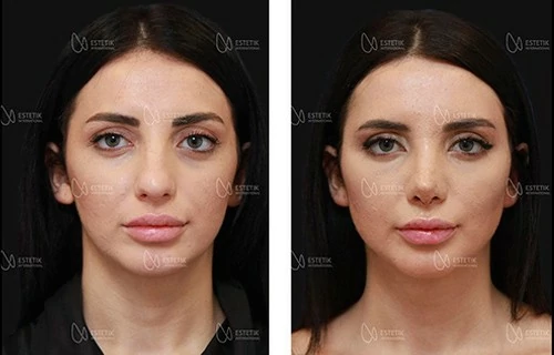 Face lifting - Spider Web