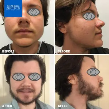 Beard transplantation in Turkey