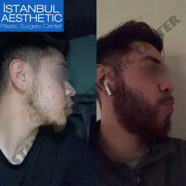 Beard transplantation in Turkey