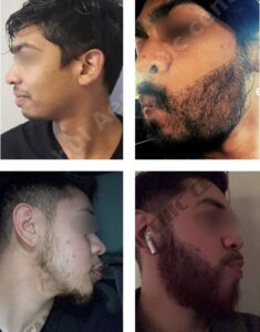 пересадка бороди в Туреччині до та після