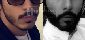 before and after beard transplant 