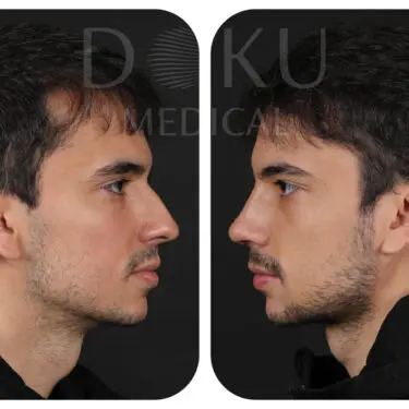Ринопластика