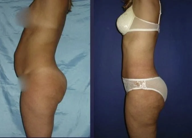 liposuction of the abdomen