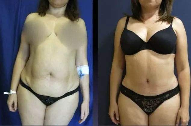 body liposuction