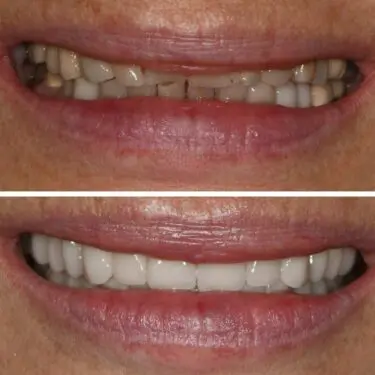 Aesthetic dentistry in Turkey