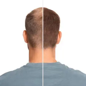 hair transplantation in Istanbul