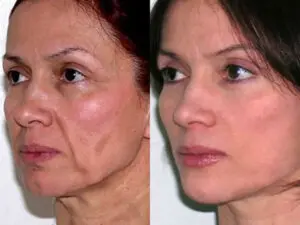  facelift surgery at NoveMed