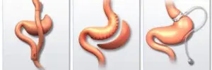 obesity surgery in istanbul