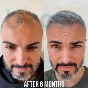 Hair transplantation