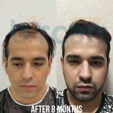Hair transplantation