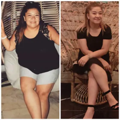 Bypass gástrico en Turquía