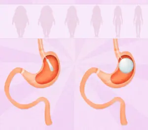How to install a gastric balloon