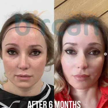 Hair transplantation