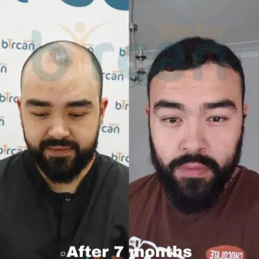 Hair transplantation