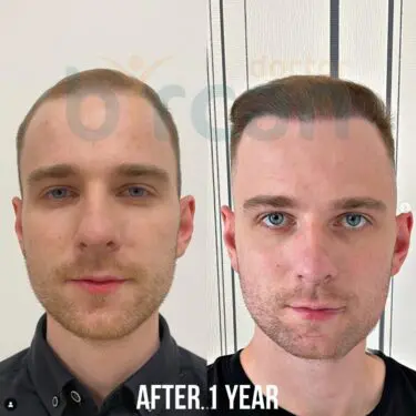 Hair transplantation