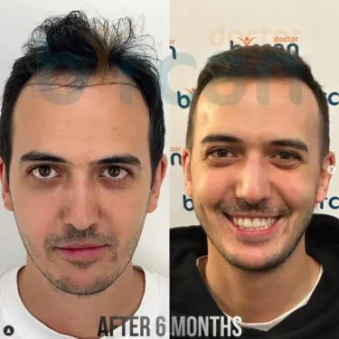 Hair transplantation