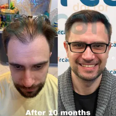 Hair transplantation
