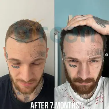 Hair transplantation