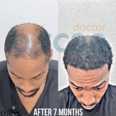 Hair transplantation