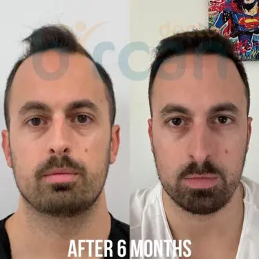 Hair transplantation