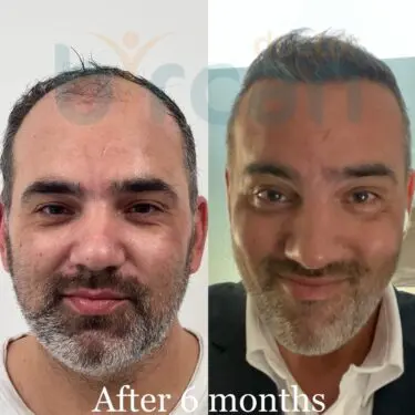 Hair transplantation