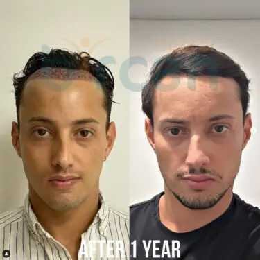 Hair transplantation
