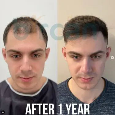 Hair transplantation