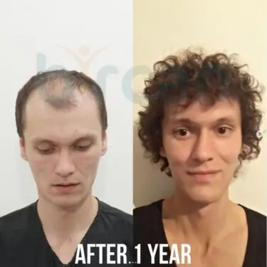 Hair transplantation