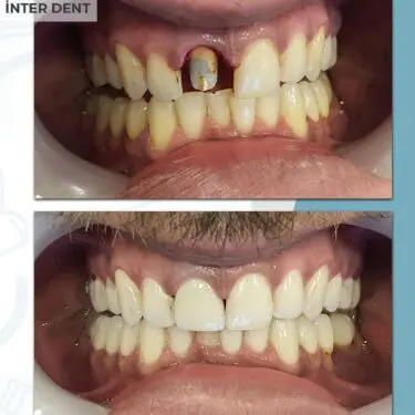 Zahnaufhellung, Restauration, Implantation