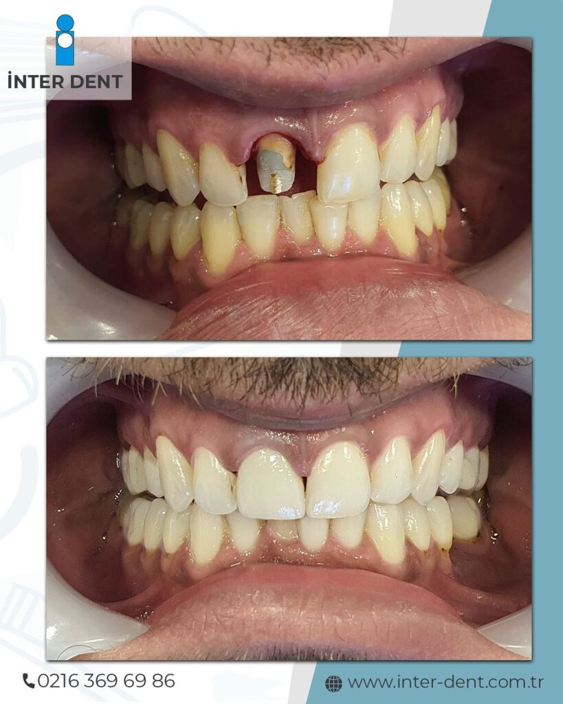 Implantación dental
