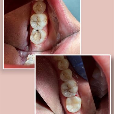 Dental treatment (filling)