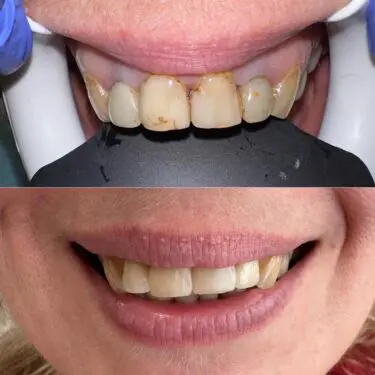 Zahnaufhellung, Restauration, Implantation