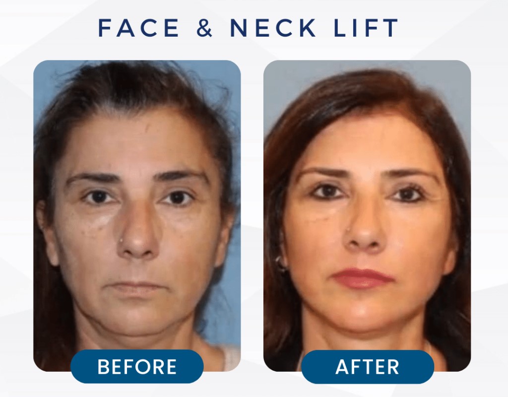 Face and neck lifting