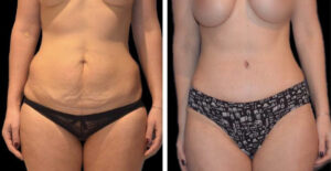 tummy tuck Turkey before and after
