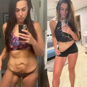 belly plastic surgery