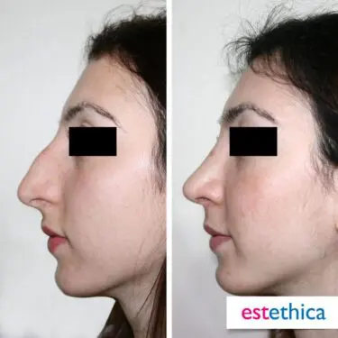 Ринопластика