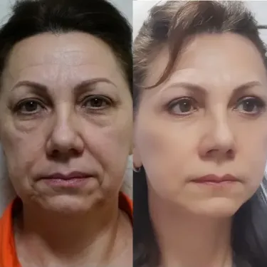 Ліфтинг обличчя в Туреччині