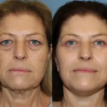 Ліфтинг обличчя в Туреччині