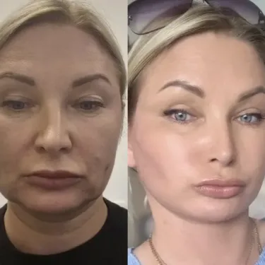 Ліфтинг обличчя в Туреччині