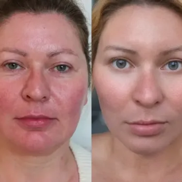 Ліфтинг обличчя в Туреччині