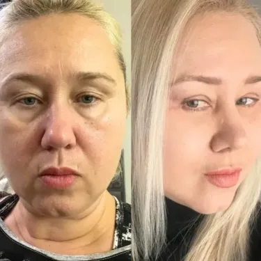 Ліфтинг обличчя в Туреччині