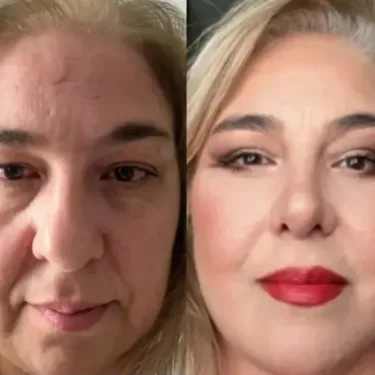 Ліфтинг обличчя в Туреччині